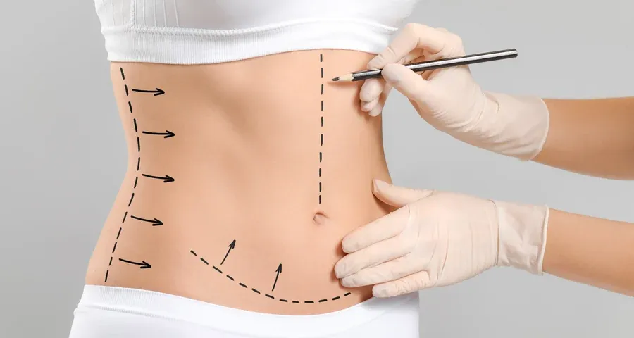 Vaser Destekli Liposuction
